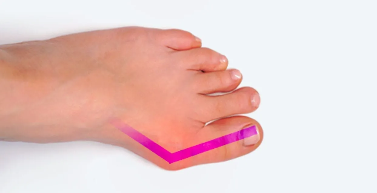 Image showing a severe bunion on the side of the big toe