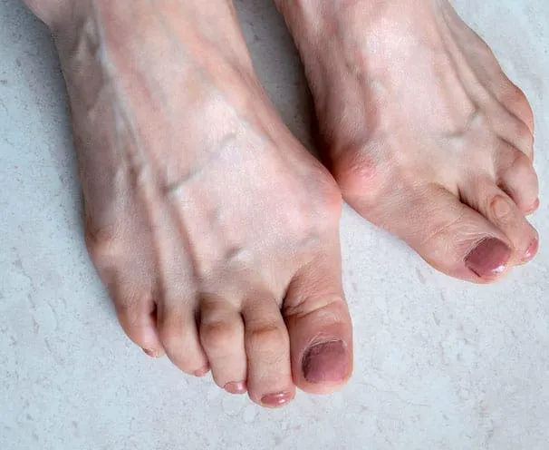 Foot types linked to hereditary bunions.