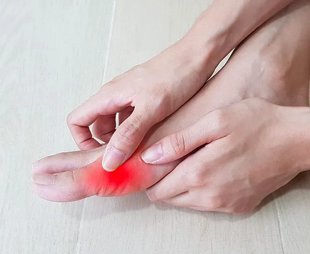 Foot injury causing structural changes leading to bunions.
