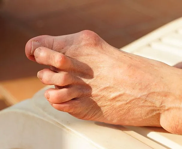 Foot with bunion caused by rheumatoid arthritis
