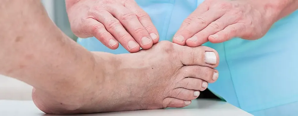 Conservative bunion treatment options