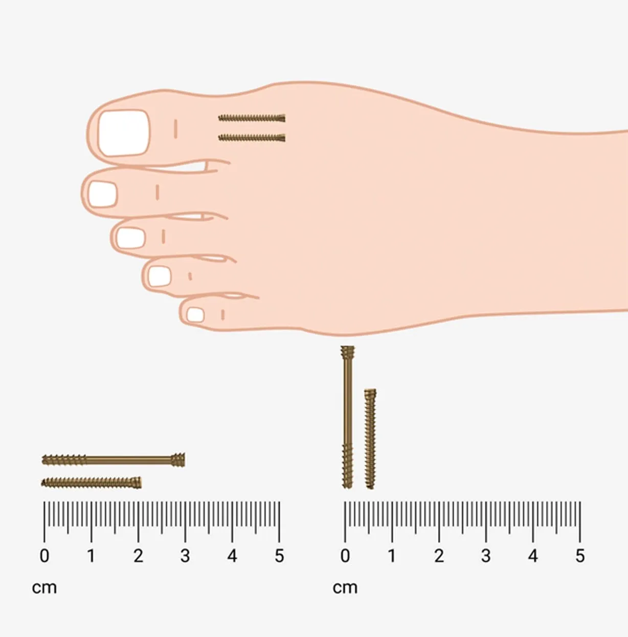 Foot with surgical screws for bunion correction and size scale.