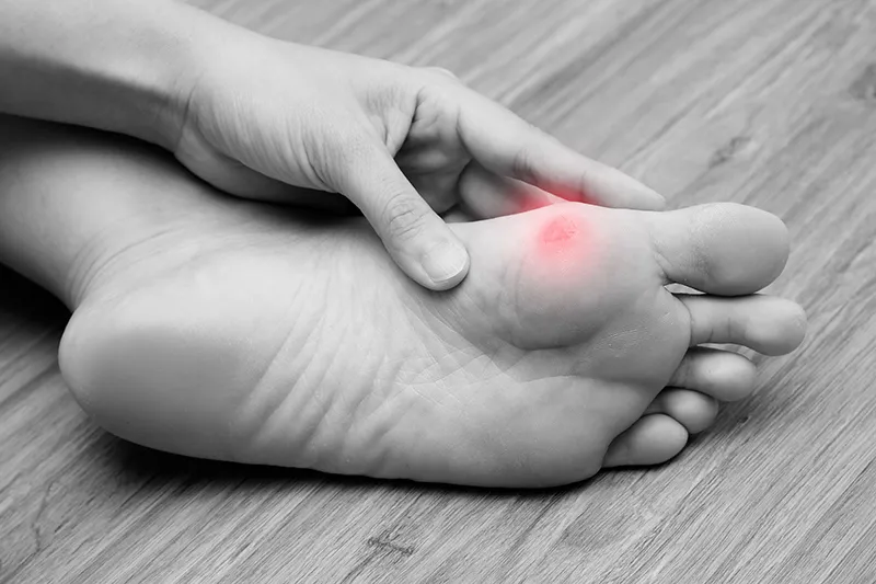 Redness indicating bunion pain in the foot.