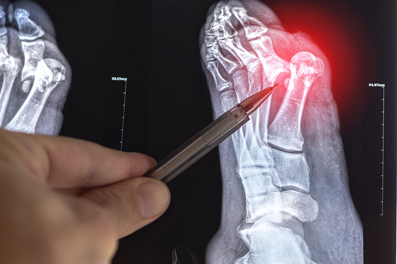 X-ray showing the presence of a bunion