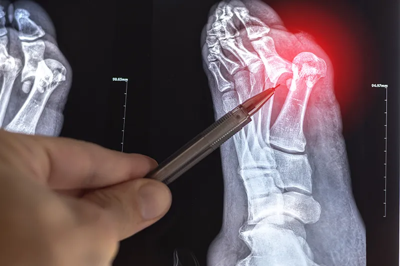 X-ray showing the presence of a bunion