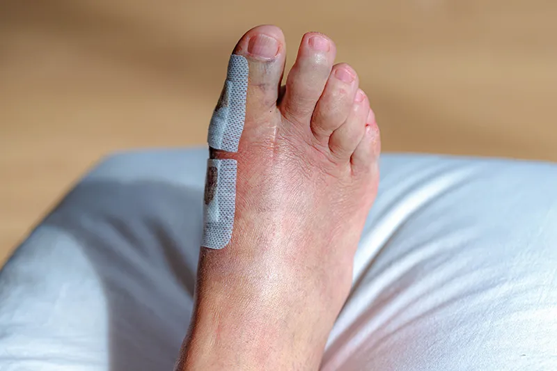 Bandaged big toe on a foot